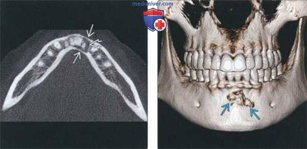 Рентгенограмма, КТ при периапикальной костной дисплазии