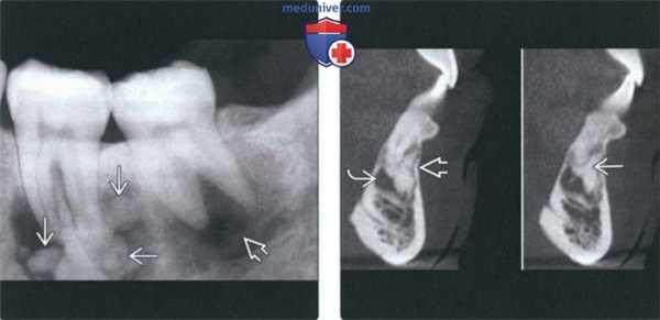 Рентгенограмма, КТ при периапикальной костной дисплазии