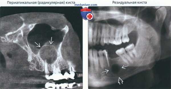 Рентгенограмма, КТ при ограниченных однокамерных просветлениях челюсти