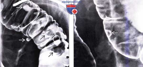 Рентгенограмма, КТ при полипе толстой кишки