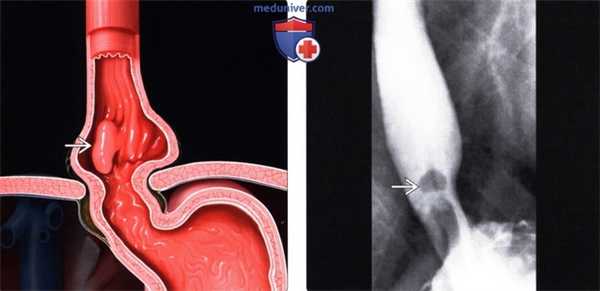 Лучевая диагностика воспалительного полипа пищевода