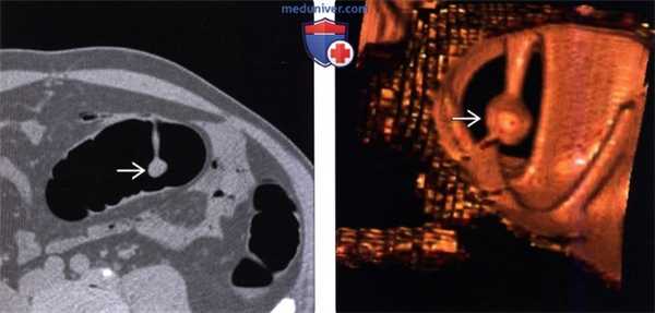 Рентгенограмма, КТ при полипе толстой кишки
