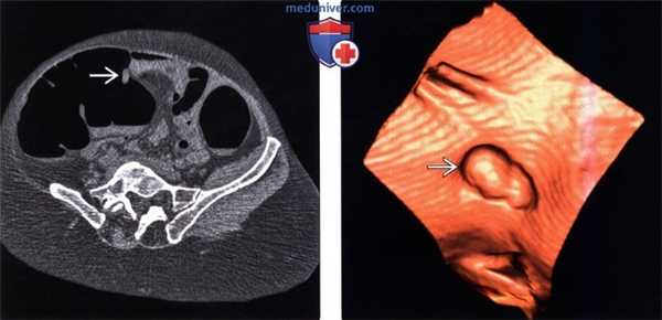 Рентгенограмма, КТ при полипе толстой кишки