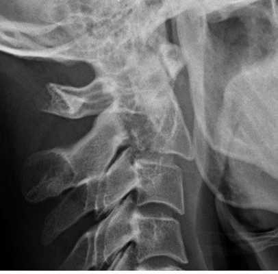 перелом повешенного