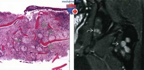 Рентгенограмма, КТ, МРТ костей при саркоидозе