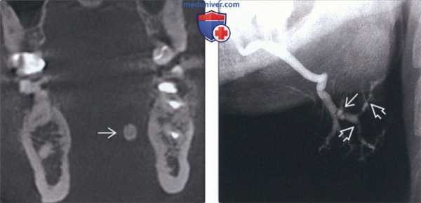 Лучевая диагностика поднижнечелюстного сиалолита