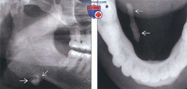 Лучевая диагностика поднижнечелюстного сиалолита