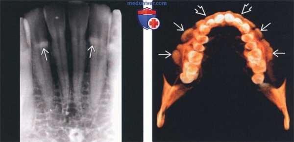 Лучевая диагностика щечных и небных экзостозов челюсти