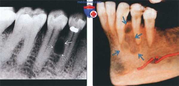 Лучевая диагностика боковой периодонтальной кисты