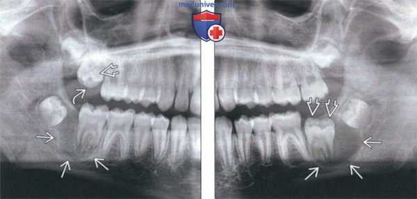 Рентгенограмма, КТ при щечной бифуркационной кисте
