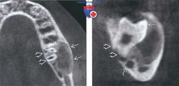 Рентгенограмма, КТ при щечной бифуркационной кисте