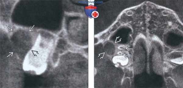 Рентгенограмма, КТ при щечной бифуркационной кисте