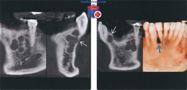 Лучевая диагностика боковой периодонтальной кисты