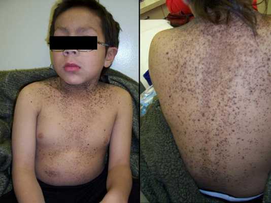 синдром базальноклеточного невуса