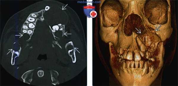 Синдром базального клеточного невуса - лучевая диагностика