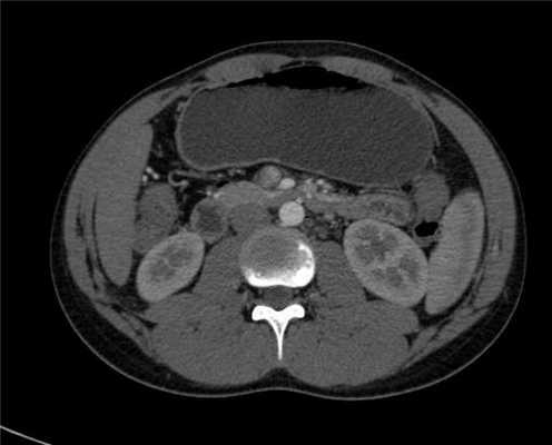 Синдром верхней брыжеечной артерии