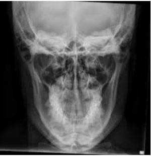 КТ челюсти фото