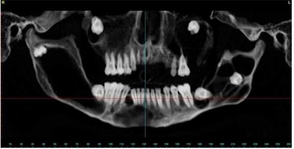 Панорамный снимок пациента