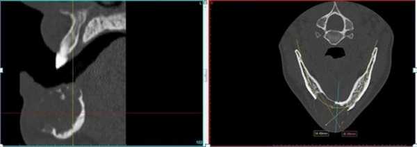 КТ свидетельствует о рецидиве кистозной формы амелобластомы