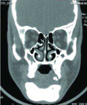 КТ челюсти и придаточных пазух