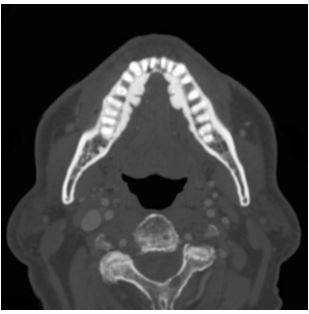 Вариант нормы на КТ челюсти