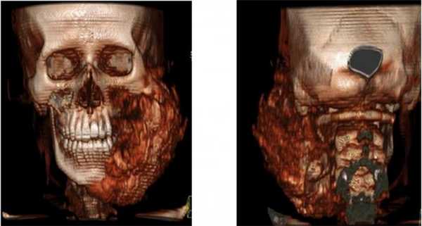 3d-реконструкция остеосаркомы