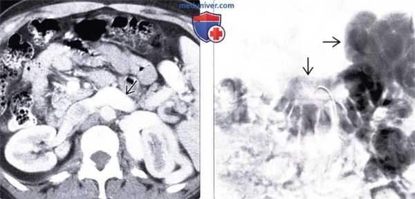 Рентгенограмма, КТ, МРТ, УЗИ при варикозном расширении пищевода