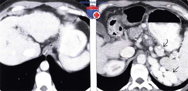 Рентгенограмма, КТ, МРТ, УЗИ при варикозном расширении пищевода