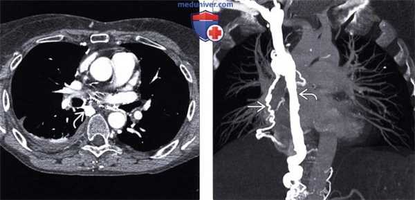 Рентгенограмма, КТ, МРТ, УЗИ при варикозном расширении пищевода