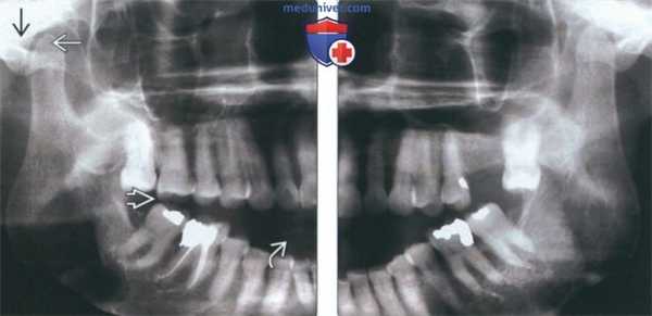 Лучевая диагностика вывиха височно-нижнечелюстного сустава (ВНЧС)
