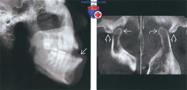 Лучевая диагностика вывиха височно-нижнечелюстного сустава (ВНЧС)