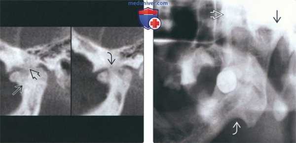 Лучевая диагностика костного анкилоза височно-нижнечелюстного сустава (ВНЧС)