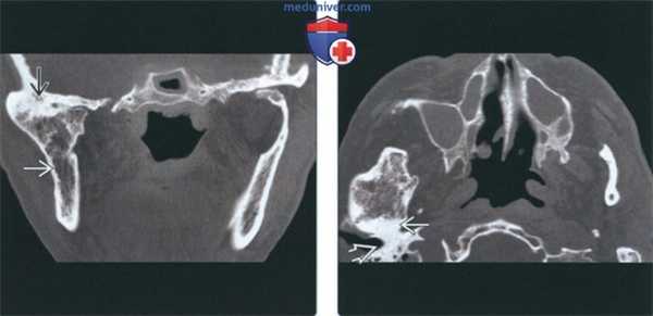 Лучевая диагностика костного анкилоза височно-нижнечелюстного сустава (ВНЧС)