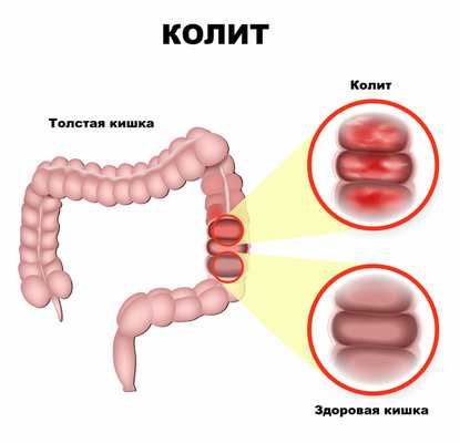 Колит.jpg