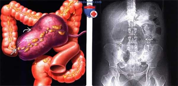 Лучевая диагностика заворота слепой кишки