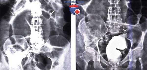 Ренгенограмма, КТ при завороте сигмовидной кишки