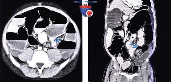 Ренгенограмма, КТ при завороте сигмовидной кишки