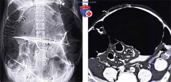Ренгенограмма, КТ при завороте сигмовидной кишки