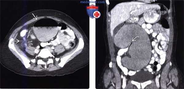 Лучевая диагностика заворота слепой кишки