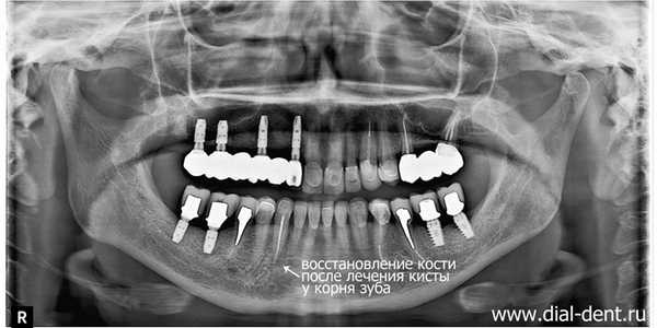 после лечения зуба с микроскопом киста устранена