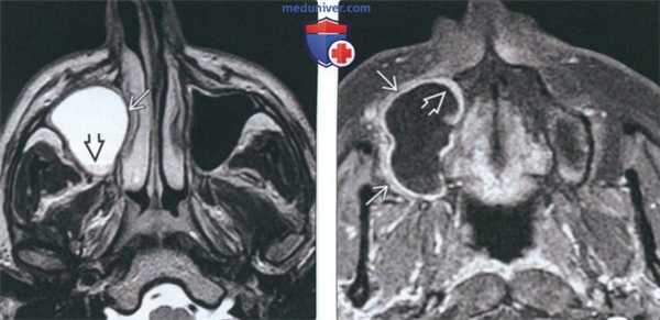 Рентгенограмма, КТ, МРТ при одонтогенной кератокисте