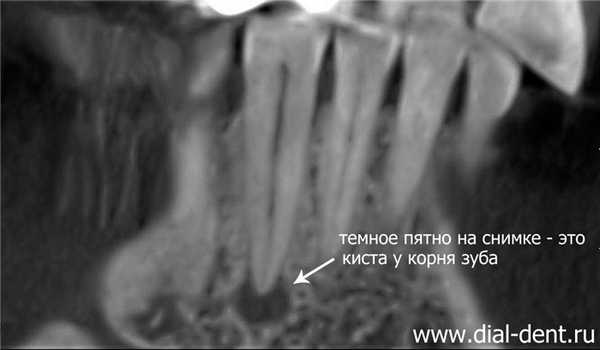 киста зуба фото