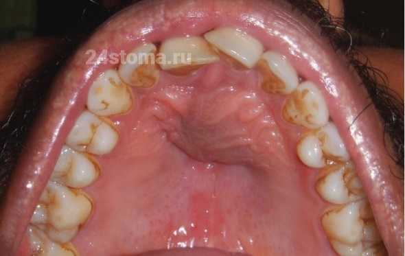 Большая корневая киста на верхней челюсти, выбухающая в сторону твердого неба