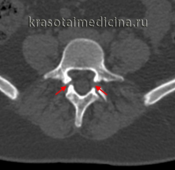 КТ ПКОП. Щель спондилолиза в области ножек позвонков с обеих сторон.