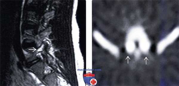 МРТ, ОФЭКТ спондилолиза