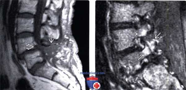 Рентгенограмма, МРТ при спондилолистезе