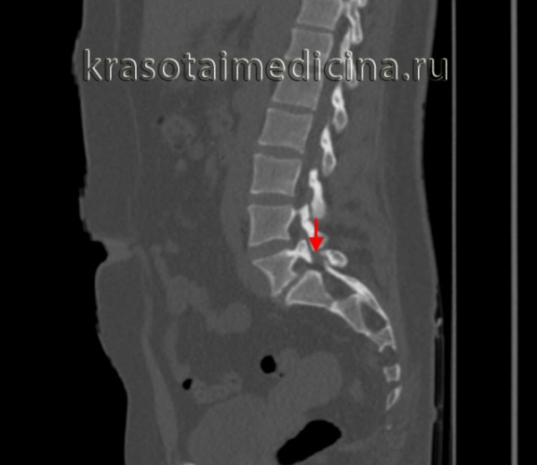 КТ пояснично-крестцового отдела позвоночника. Нарушение целостности задних отделов позвонка без существенного спондилолистеза.