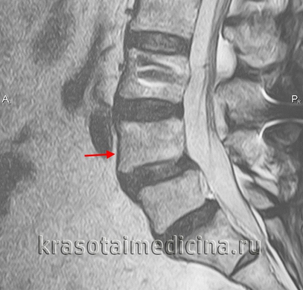 МРТ поясничного отдела позвоночника. Смещение L4 кпереди (спондилолистез 1-й ст.)