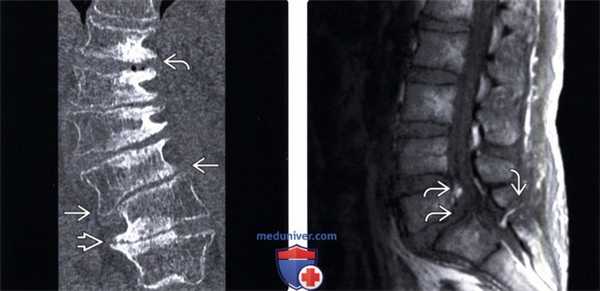 Рентгенограмма, МРТ при спондилолистезе