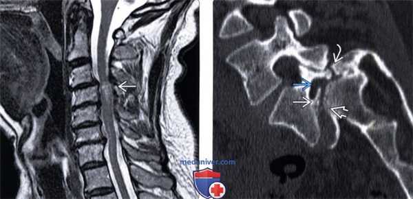 Рентгенограмма, МРТ при спондилолистезе